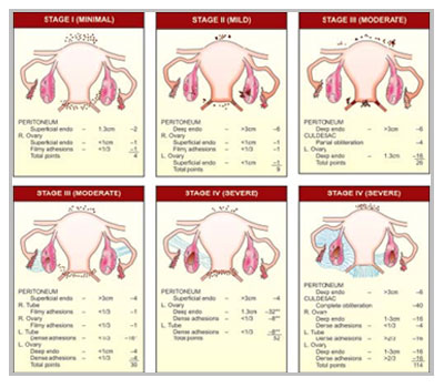 Best infertility doctor in Delhi NCR